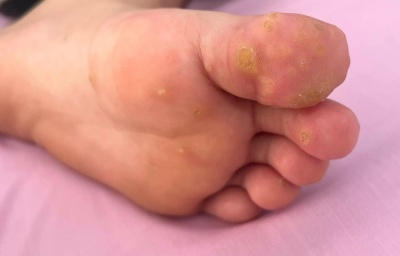 KHÔNG CHỦ QUAN VỚI MỤN CÓC LÒNG BÀN TAY, BÀN CHÂN.